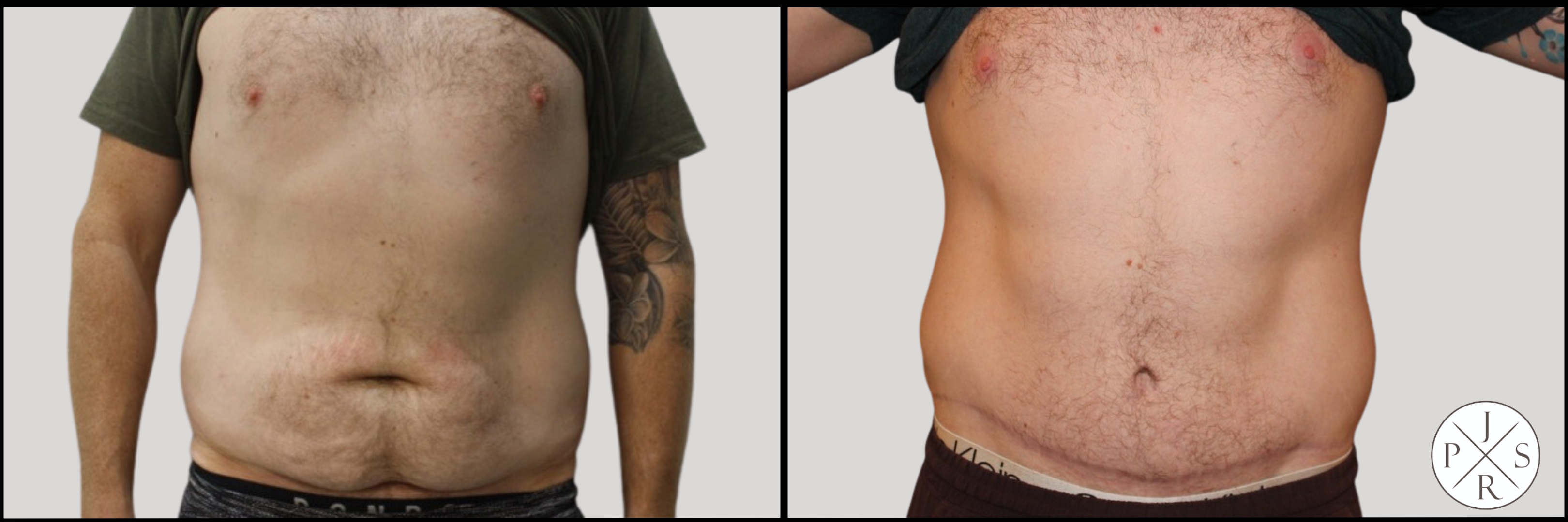 Abdominoplasty Before & After Image